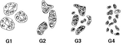 보고서 Figure 3 — 암의 분화도 G1(고분화)에서 G4(미분화)까지. 오른쪽으로 갈수록 세포가 정상세포와 멀어져 어떤 세포에서 기원했는지 구별이 불가능해진다(National Cancer Institute).