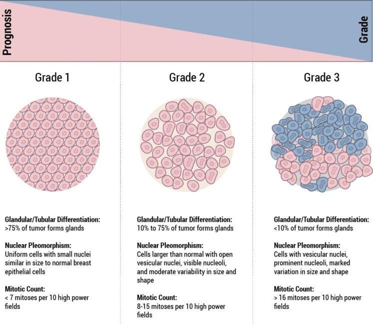 보고서 Figure 4 — 유방암 등급을 가르는 세 요인. 샘 구조의 비율(Grade 1 >75% / Grade 2 10–75% / Grade 3 16)가 등급별로 잘려 있다.