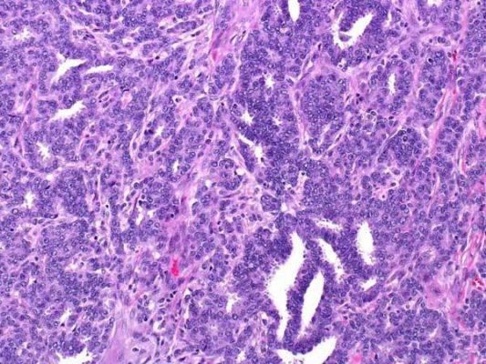2급 — tubular gland structure를 형성하고 있지만 일부 영역에 비정형 핵을 포함하는 nests of cells가 잘 형성되지 않은 모습. 이 정도의 핵 경계를 CNN이 읽어야 한다는 것이 전처리 설계의 목표였다.