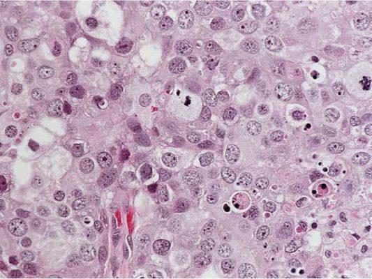 3급 — 뚜렷한 핵 이형성과 유사분열을 가진 nests of cells. 핵의 크기와 모양이 제각각이고 샘 구조는 보이지 않는다.